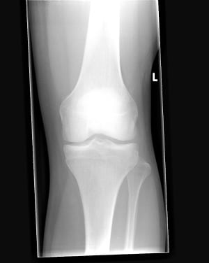 Knee_Front_X-ray-Wiki