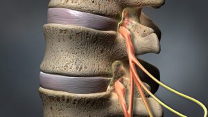 spinal stenosis treatment Buckhead